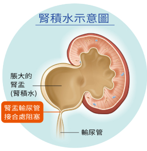 腎積水示意圖