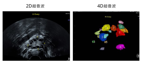 透過4d超音波 更能輔助檢測不孕症 提升植入成功率 台中茂盛醫院生殖醫學中心