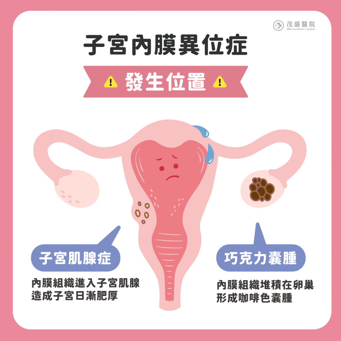 子宮內膜異位是什麼？